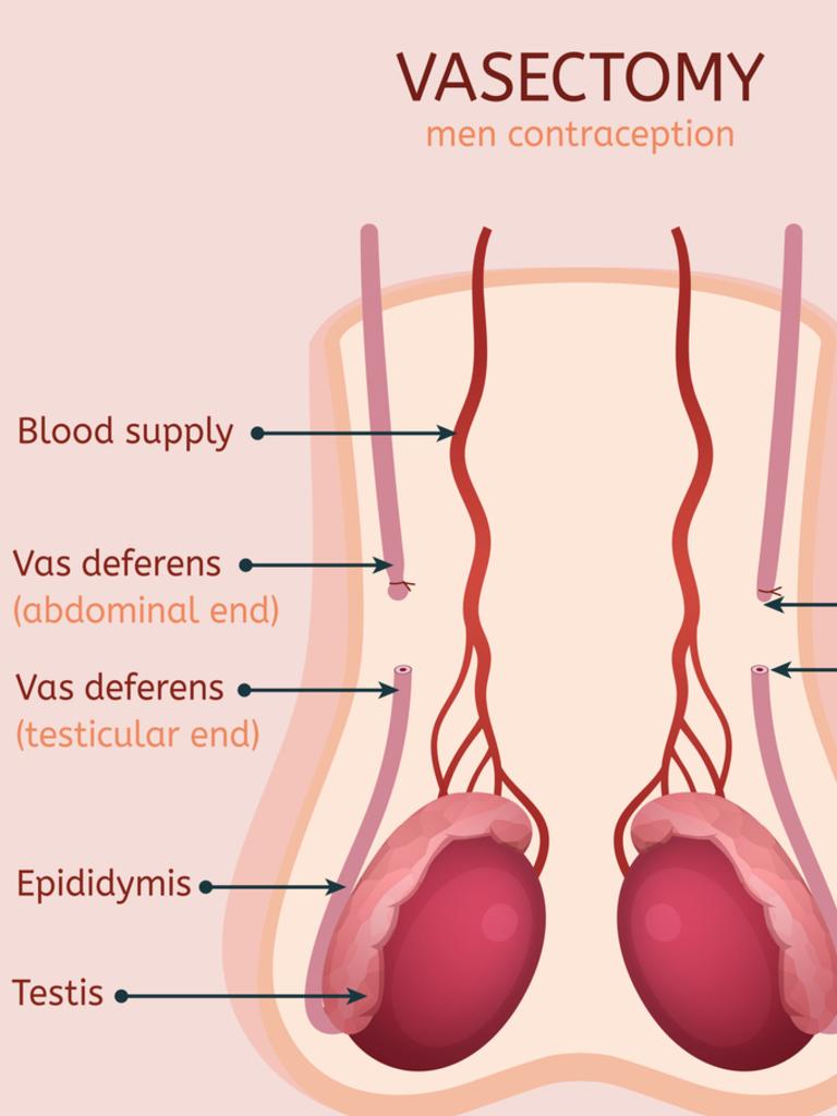 Does Insurance Cover Vasectomy? MSI Vasectomy