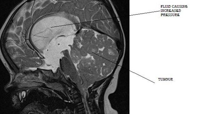 A brain scan with a tumour.