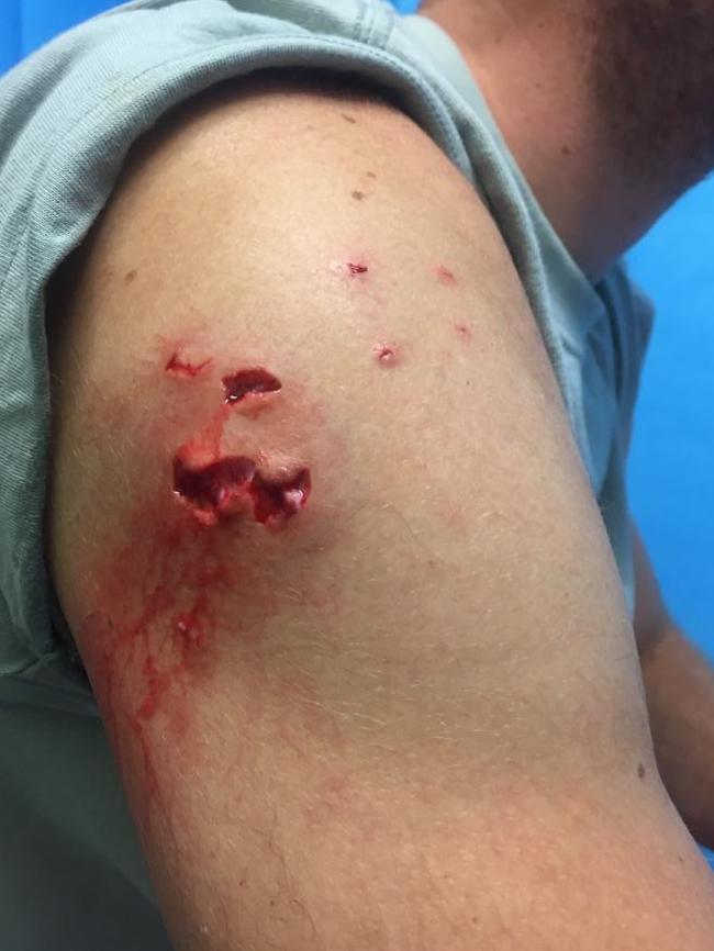 The Brit was bit at least once on the arm, but managed to fight the shark off. Picture: Supplied