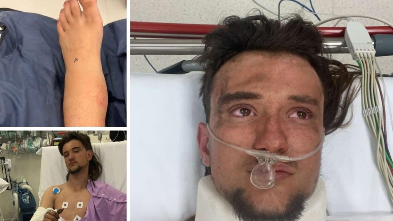 Teen worker Ethan Avenell was partially crushed by a mine truck tyre part on August 16, 2024 at Peabody's Moorvale Mine in Coppabella, Queensland. He suffered a broken ankle, and two breaks to his arm. Picture: Ethan Avenell