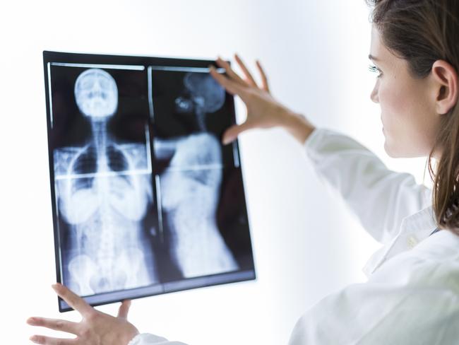 A mammogram saved Kate’s life. Picture: iStock