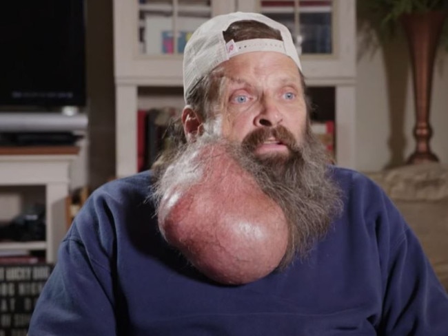 Tim, 62, had a watermelon sized tumour growing out of his face, which swelled in size over 16 sixteen years. Picture: YouTube/TLC