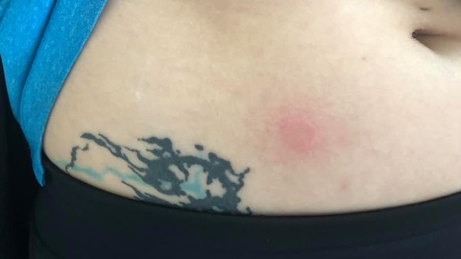 The woman shows her injury after being shot with a gel blaster gun in Toowoomba.