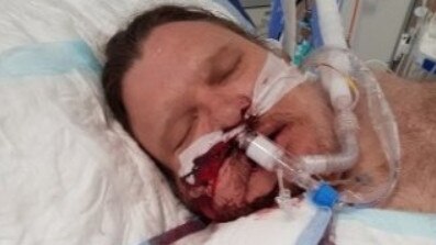 Philip Stennett spent weeks in an intensive care unit in Newcastle after half of his jaw, tongue and the right side of his face were blasted off. Supplied.