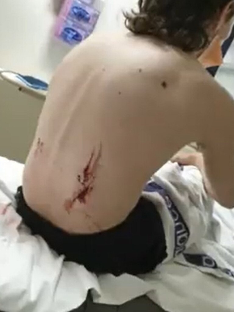 Jack Shaw suffered a centimetre-deep gash to his back when he was attacked by a shark at Ocean Grove. Picture: Channel 9