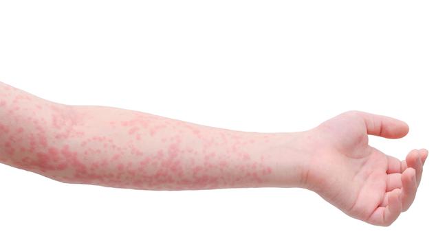 A rash is the one of the milder symptoms of measles.