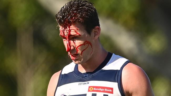 A bloodied osh Jenkins leaves the field after colliding with teammate Charlie Constable.