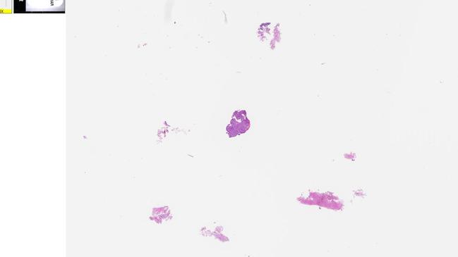 The pathology slide which shows a contaminant piece of tissue (centre) as compared to the otherwise non-cancerous tissue taken from a biopsy of Mr Jackson's lung. Picture: SA Coroner's Court