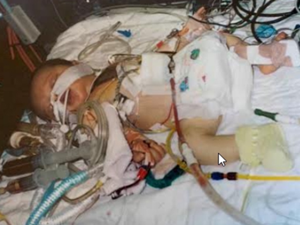 When she was just three days old, she had her first heart surgery. Picture: Supplied