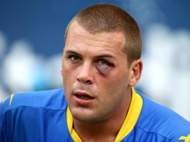 Parramatta's Danny Wicks sports a black eye during the Round 4 NRL game between the Wests Tigers and the Parramatta Eels at ANZ Stadium.Picture Gregg Porteous