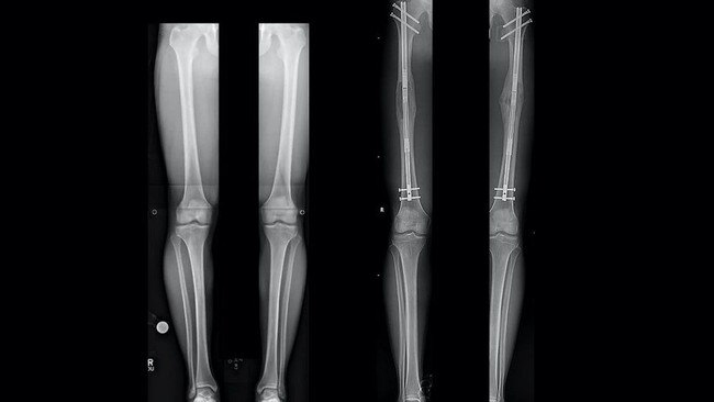 An X-ray from a patient's legs before (left) and after (right) the operation, showing the metal rods he was fitted with. Picture: Dr S Robert Rozbruch