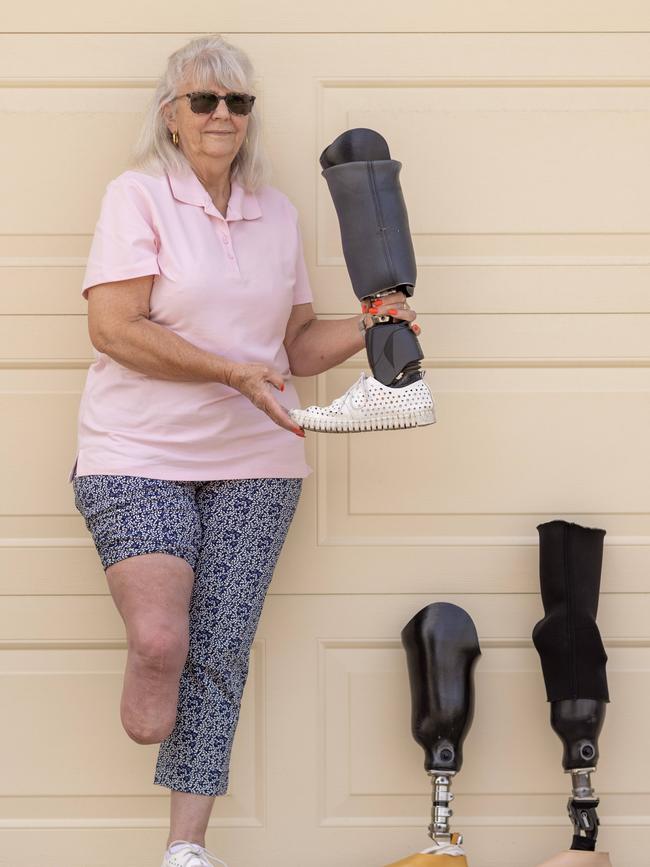 Three years later – after three operations on her foot and still only being able to stand for 10 minutes without needing to rest. Picture: Kelly Barnes