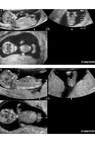 44+ 13 week ultrasound gender prediction image ideas