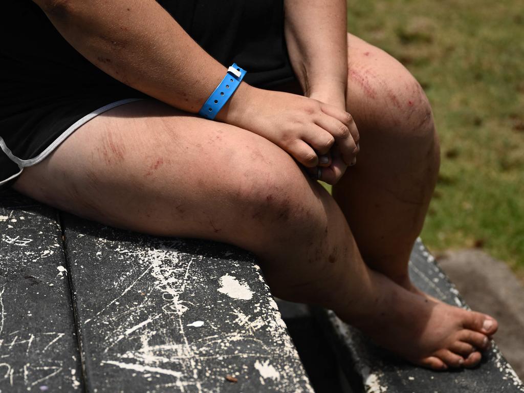 Cuts and burns are seen on Lahaina resident Annelise Cochran's body, as she speaks about her harrowing escape from the flames of the Maui Fires. Picture: AFP