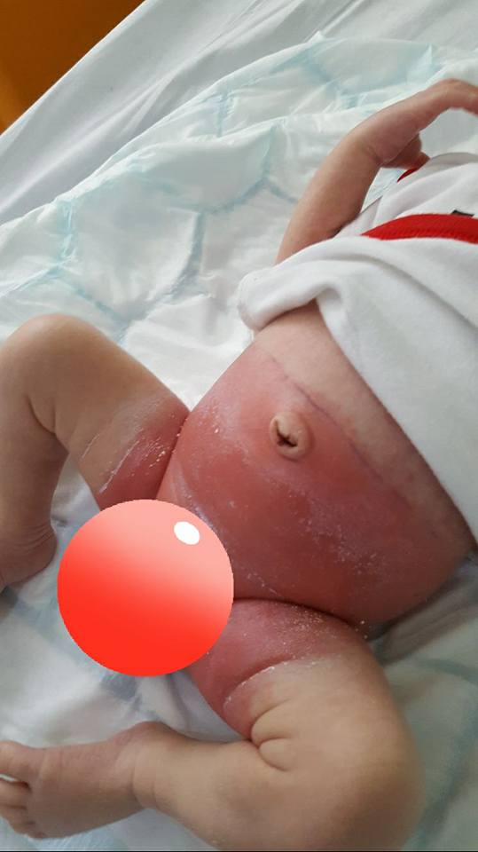 Newborn store nappy rash