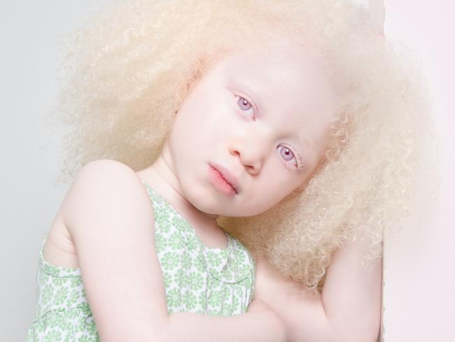 Photo essay - Albinism | Albinos Picture: Angelina d’Auguste