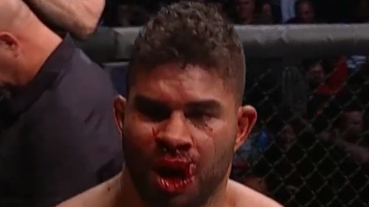 Alistair Overeem’s busted lip in closing seconds of his UFC bout