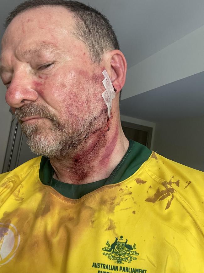 Labor federal MP Graham Perrett after copping a boot to the face during the Parliamentary Rugby World Cup in France in September. Picture: Supplied.