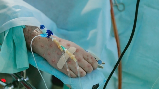 NSW Health warns of ‘likely’ monkeypox transmission in Australia | Sky ...