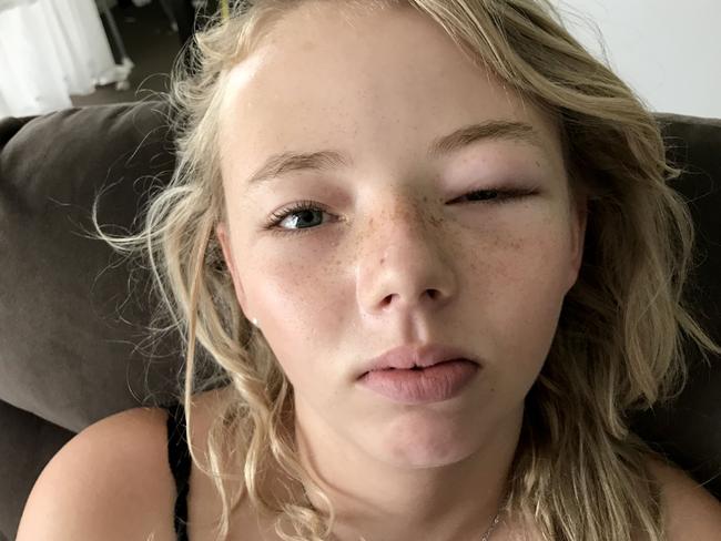 Brisbane teen Angel Boulton had a severe allergic reaction after using a Kmart eye mask on the weekend. Picture: Clare Boulton/Caters News