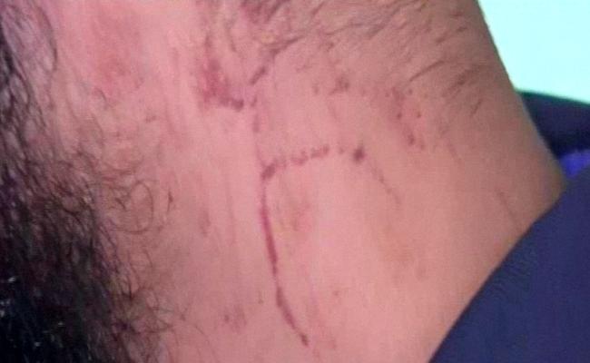 Eathan Cruse shows bruises on his neck he says were the result of police. Picture: Channel 9.