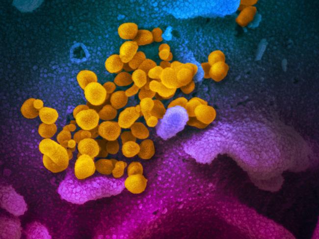 TOPSHOT - This handout illustration image obtained February 27, 2020 courtesy of the National Institutes of Health taken with a scanning electron microscope  shows SARS-CoV-2 (yellow)—also known as 2019-nCoV, the virus that causes COVID-19—isolated from a patient in the US, emerging from the surface of cells (blue/pink) cultured in the lab. - President Donald Trump has played down fears of a major coronavirus outbreak in the United States, even as infections ricochet around the world, prompting a ban on pilgrims to Saudi Arabia. China is no longer the only breeding ground for the deadly virus as countries fret over possible contagion coming from other hotbeds of infection, including Iran, South Korea and Italy. There are now more daily cases being recorded outside China than inside the country, where the virus first emerged in December, according to the World Health Organization. (Photo by Handout / National Institutes of Health / AFP) / RESTRICTED TO EDITORIAL USE - MANDATORY CREDIT "AFP PHOTO /NATIONAL INSTITUTES OF HEALTH/NIAID-RML/HANDOUT " - NO MARKETING - NO ADVERTISING CAMPAIGNS - DISTRIBUTED AS A SERVICE TO CLIENTS