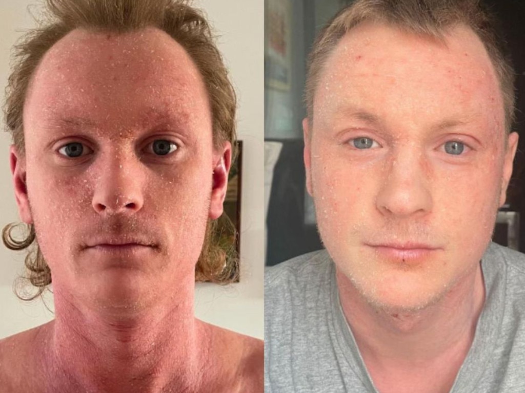 Before and after pics of Jordan Hendey's recovery journey from TSW. Picture: Supplied.