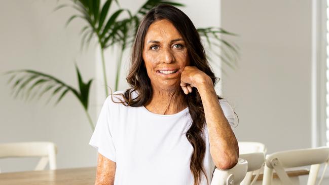 Turia Pitt says she chooses to ignore online hate. Picture: Supplied