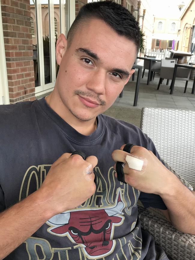 Tim Tszyu has swollen hands after undergoing surgery to repair damaged nerves. Picture: Jamie Pandaram