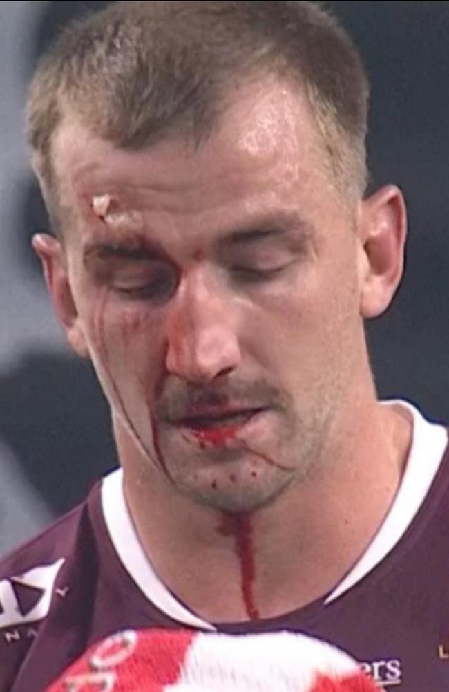 Manly hooker Lachlan Croker cops a cut in Vegas. Picture: Fox League