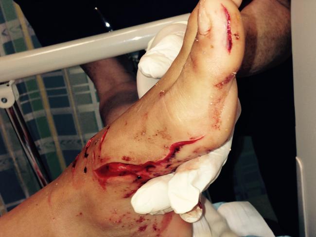 Promising surfer Kirra-Belle Olsson was bitten on the foot by a wobbegong shark at Avoca in 2014. Photo supplied