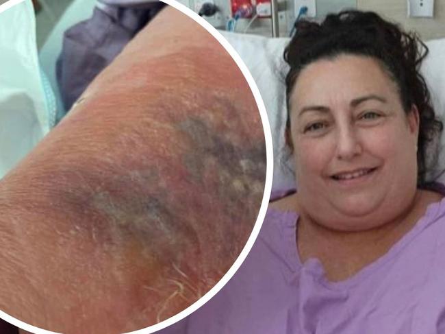 âVolcano erupting under my skinâ: Woman nearly loses leg after ocean swim