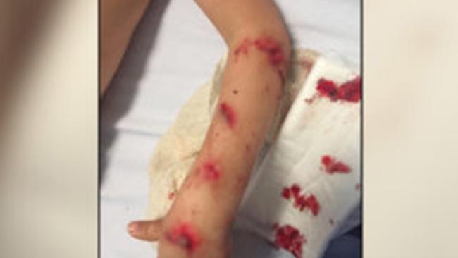 Megan Tilbury’s four year old son was injured after their shower screen shattered. Picture: Supplied