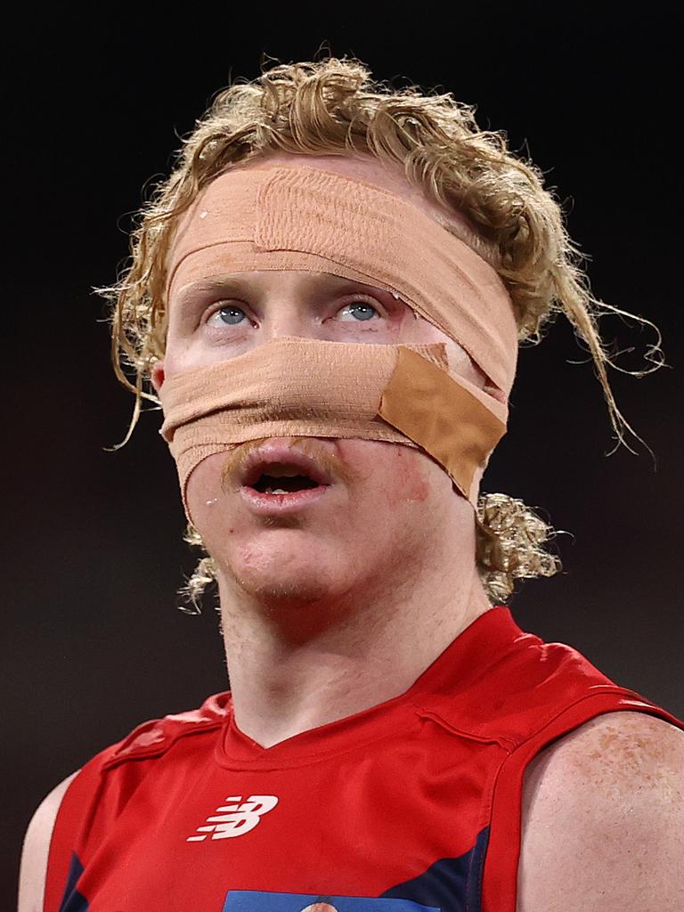 A battered and bruised Clayton Oliver was enormous for the Demons. Picture by Michael Klein