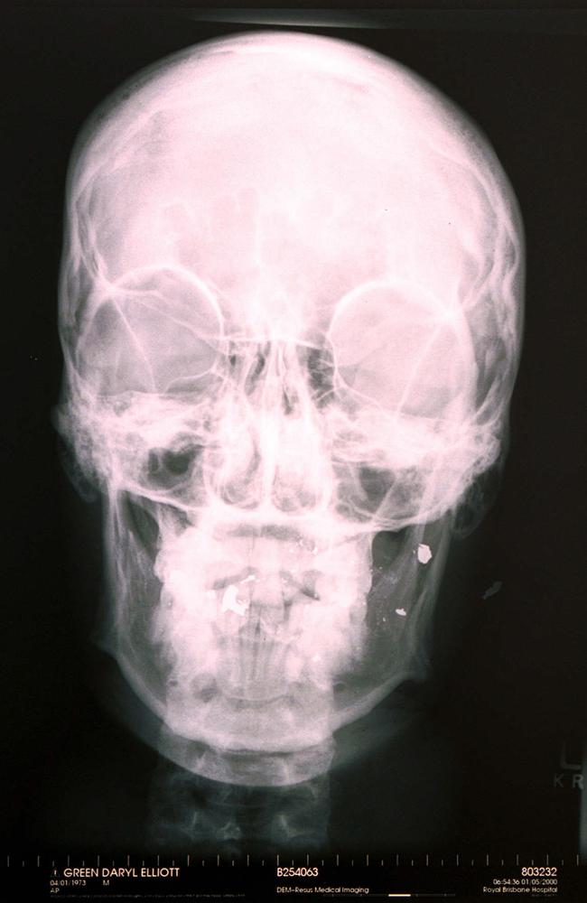 The X-ray of Daryl’s head after the shooting, showing the bullet and shrapnel.