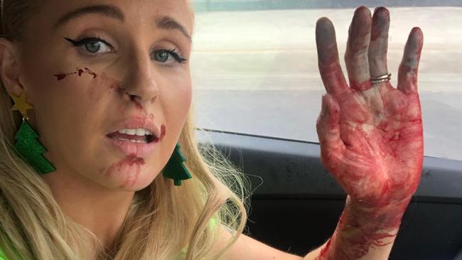 Annie Nolan was injured after breaking up a dogfight. Picture: Supplied