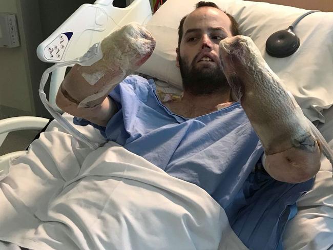 Jake Clift, in hospital following his amputations. Picture: Gofundme