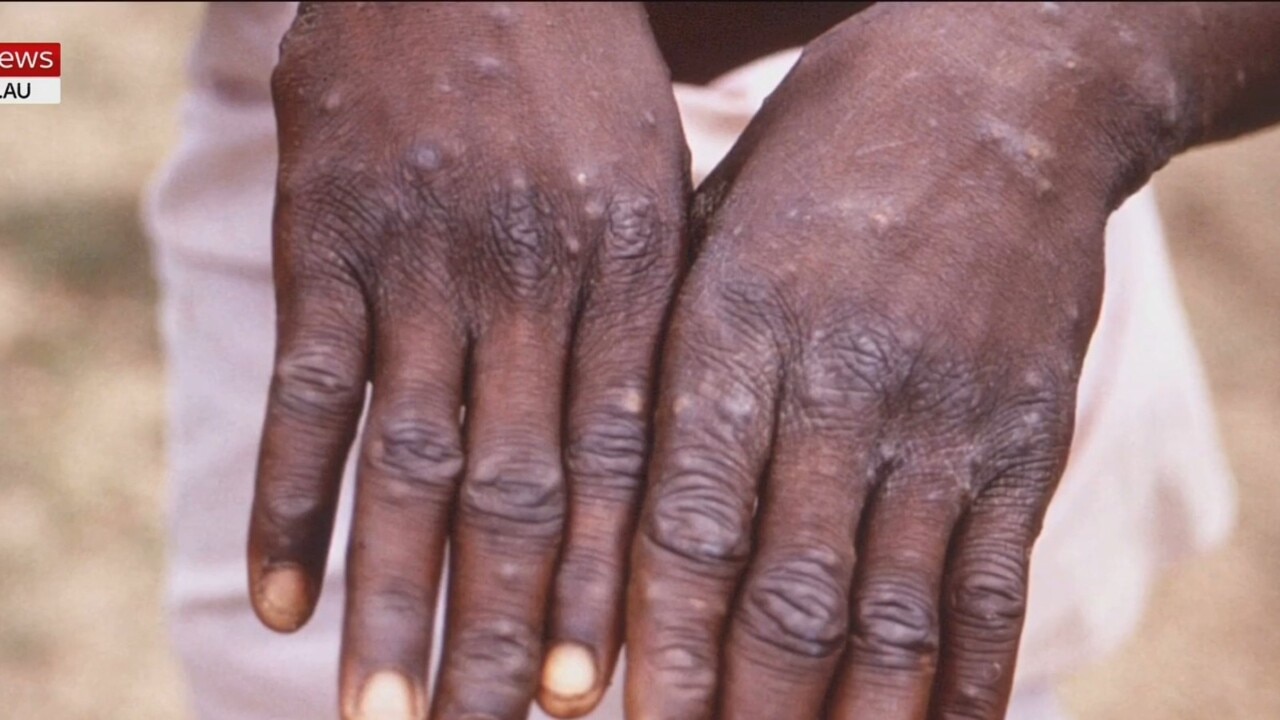 Monkeypox detected across 15 countries