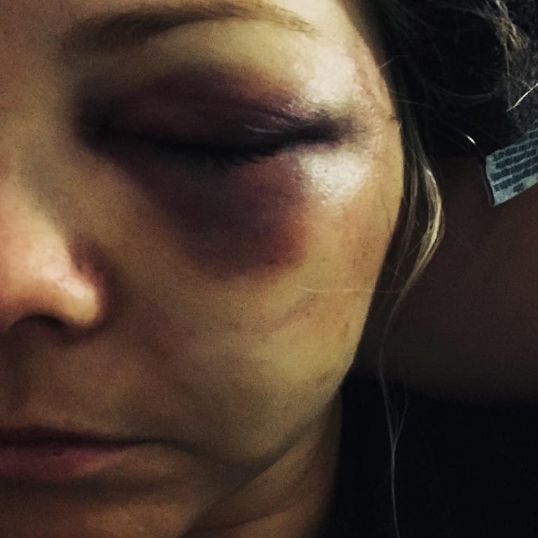 Jake Frecker did severe damage to her left eye.