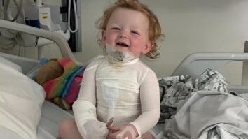 Amarnie Grace needs skin grafts after being badly burned by boiling tea.