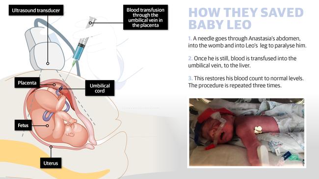 How Mercy Hospital specialists saved baby Leo.