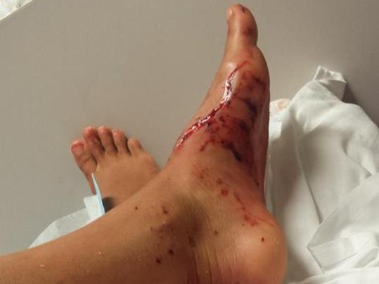 Kirra-belle Olsson’s dad posted to Facebook after she was attacked by a shark at Avoca Beach. Picture: Facebook