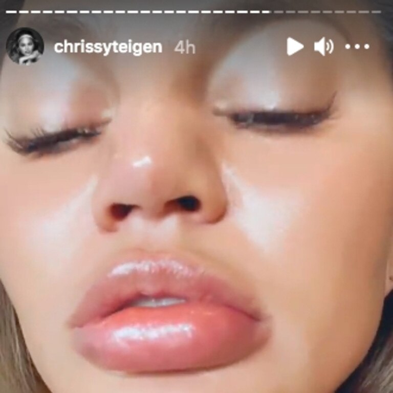 She said she didn’t get lip fillers. Picture: Instagram