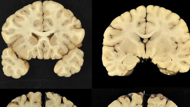 Research into the effects of concussion.