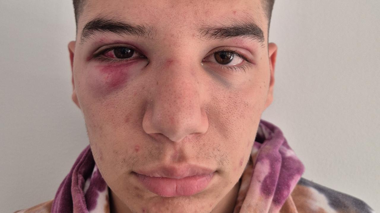 Mum slams school for ‘ignoring’ son’s brutal bashing