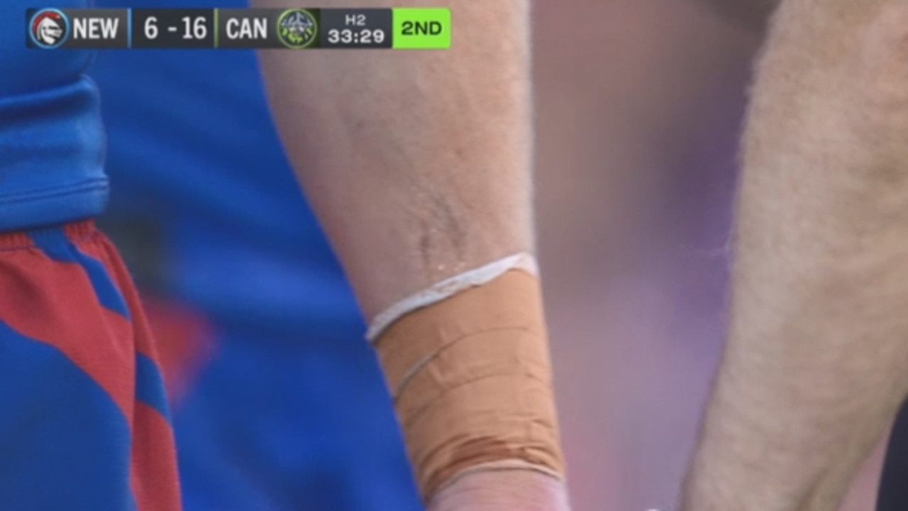 Tyson Gamble’s arm with clear bite marks.