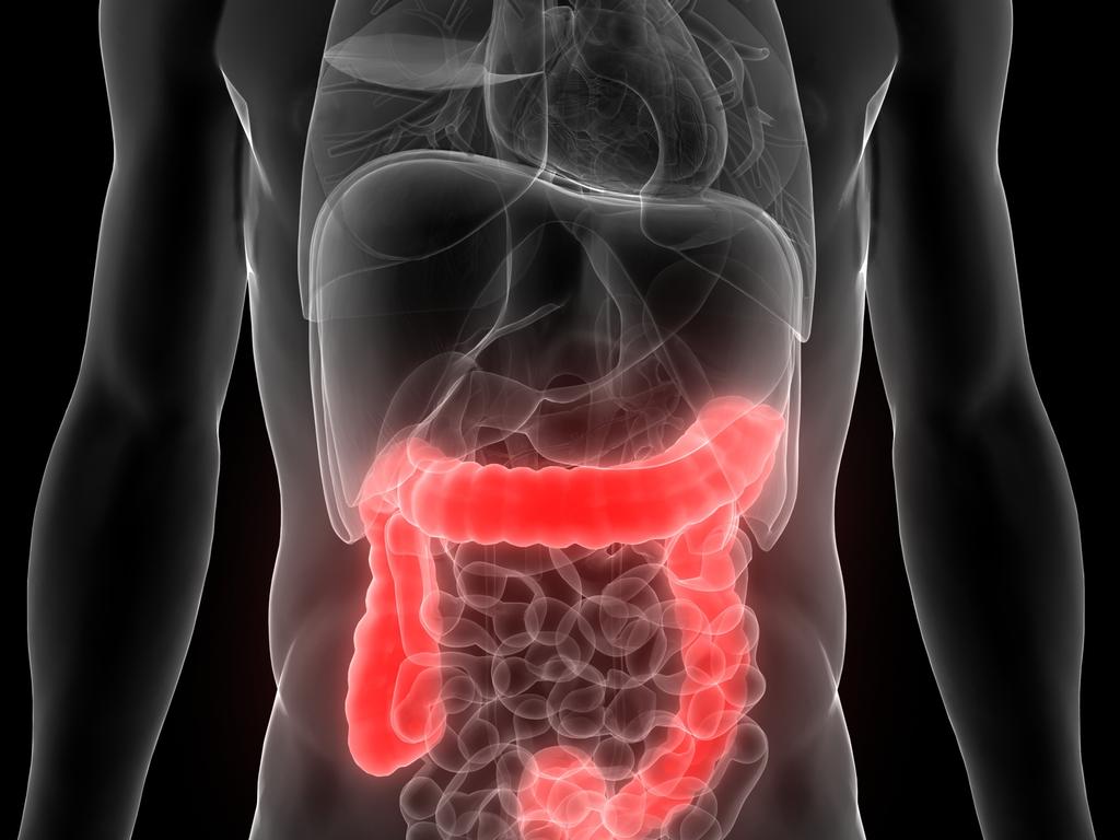 Young adults who develop colon cancer tend to be diagnosed at later stages of the devastating disease.