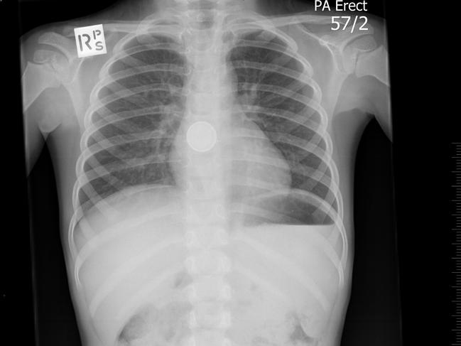 If a parent suspects a child has swallowed a battery button, they should get an x-ray. Picture: Supplied