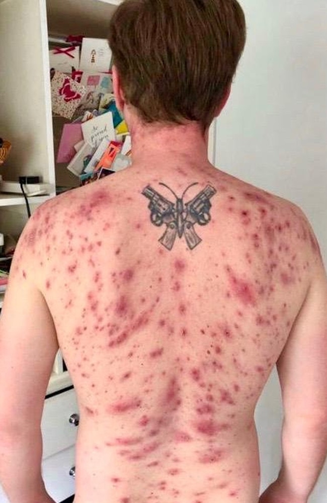 James had a terrible outbreak of severe acne on his back. Picture: SWNS / Mega