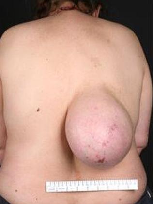 Woman has 'breast' on her back   — Australia's leading